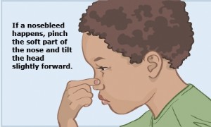 Nasenbluten 