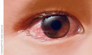 Pinkeye 