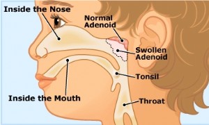 Adenoide und Adenoidektomien 