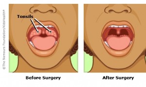 Herausnehmen der Mandeln 