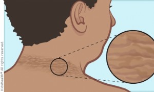 Akanthose Nigricaner