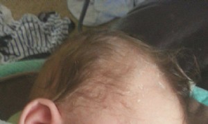 Arten von Babyausschlägen 