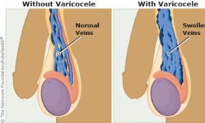Varikozele 
