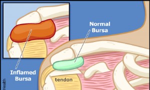 Bursitis 