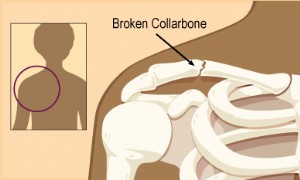 Gebrochenes Schlüsselbein (Schlüsselbeinfraktur) 