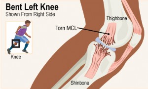 Verletzungen des medialen Kollateralbandes (MCL) 