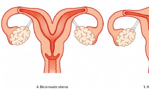Uterusanomalie - Probleme mit der Gebärmutter 