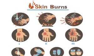 Erste Hilfe bei Verbrennungen:Wie man jede Art von Verbrennung behandelt und heilt 