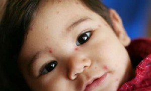 Exposition gegenüber Windpocken oder Röteln während der Schwangerschaft 