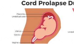 Nabelschnurvorfall während der Schwangerschaft 