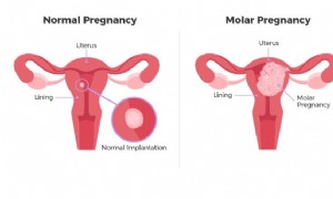 Molenschwangerschaft 