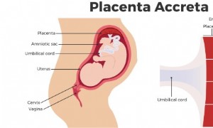 Plazenta accreta 