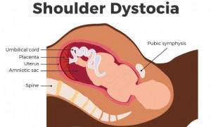 Schulterdystokie während der Schwangerschaft 