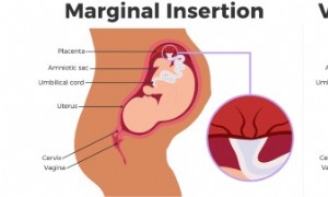 Was ist das Einführen von Velamentous Cord? 