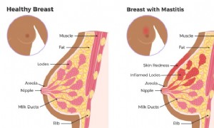 Mastitis während des Stillens 