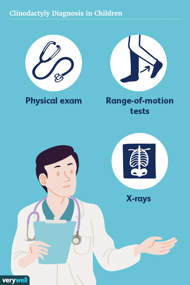 Ein Überblick über Clinodaktylie 