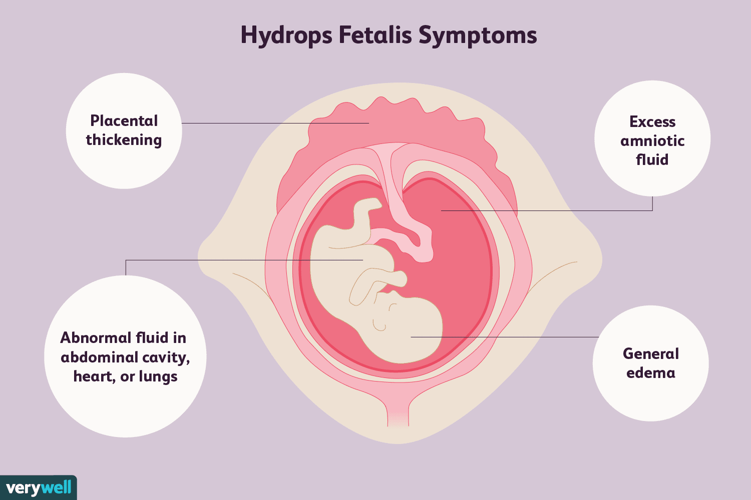 Ein Überblick über Hydrops fetalis 